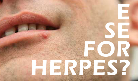 herpes